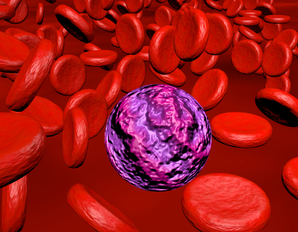 A computer rendering of an Acute Myeloid Leukaemia cell